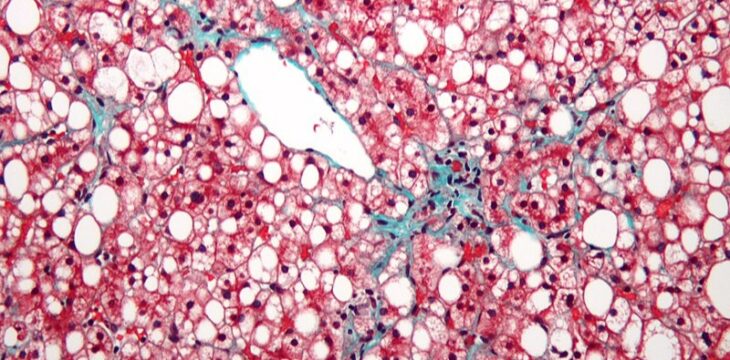 Fettleber natürlich in den Griff bekommen: Ayurvedische Kräuter, Fasten und Detox-Praktiken